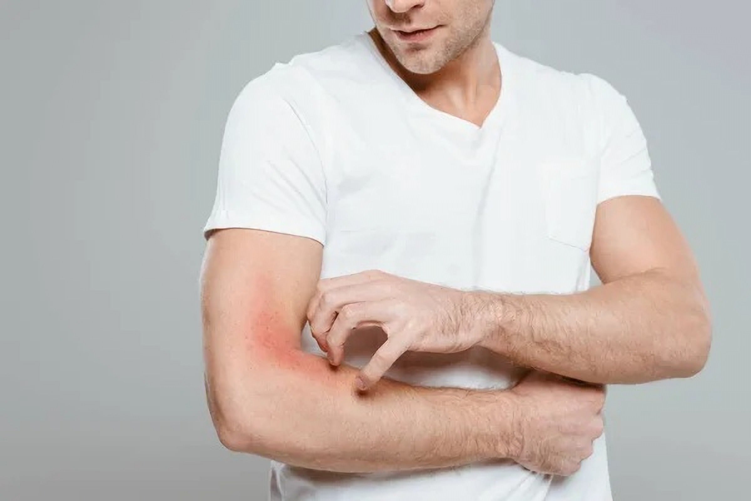 Eczema: Information, Triggers & Management